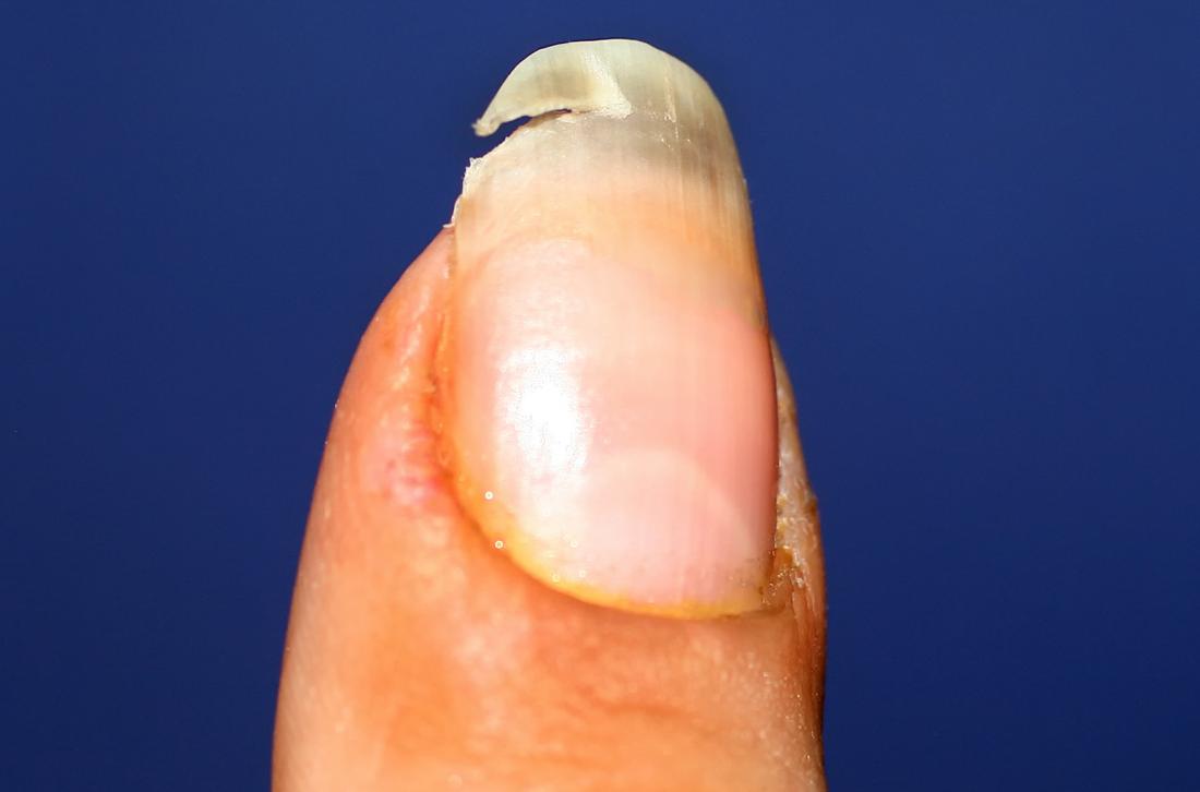 Nail abnormalities: Causes, symptoms, and pictures