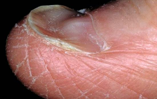 koilonychia or spoon shaped nails known as spooning