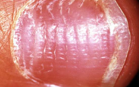 Nail pitting