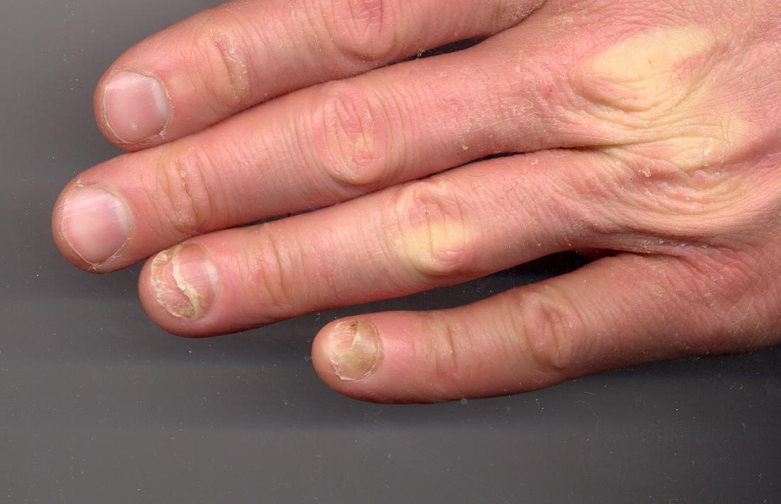 onycholysis. image credit copperkettle 2012 september 9