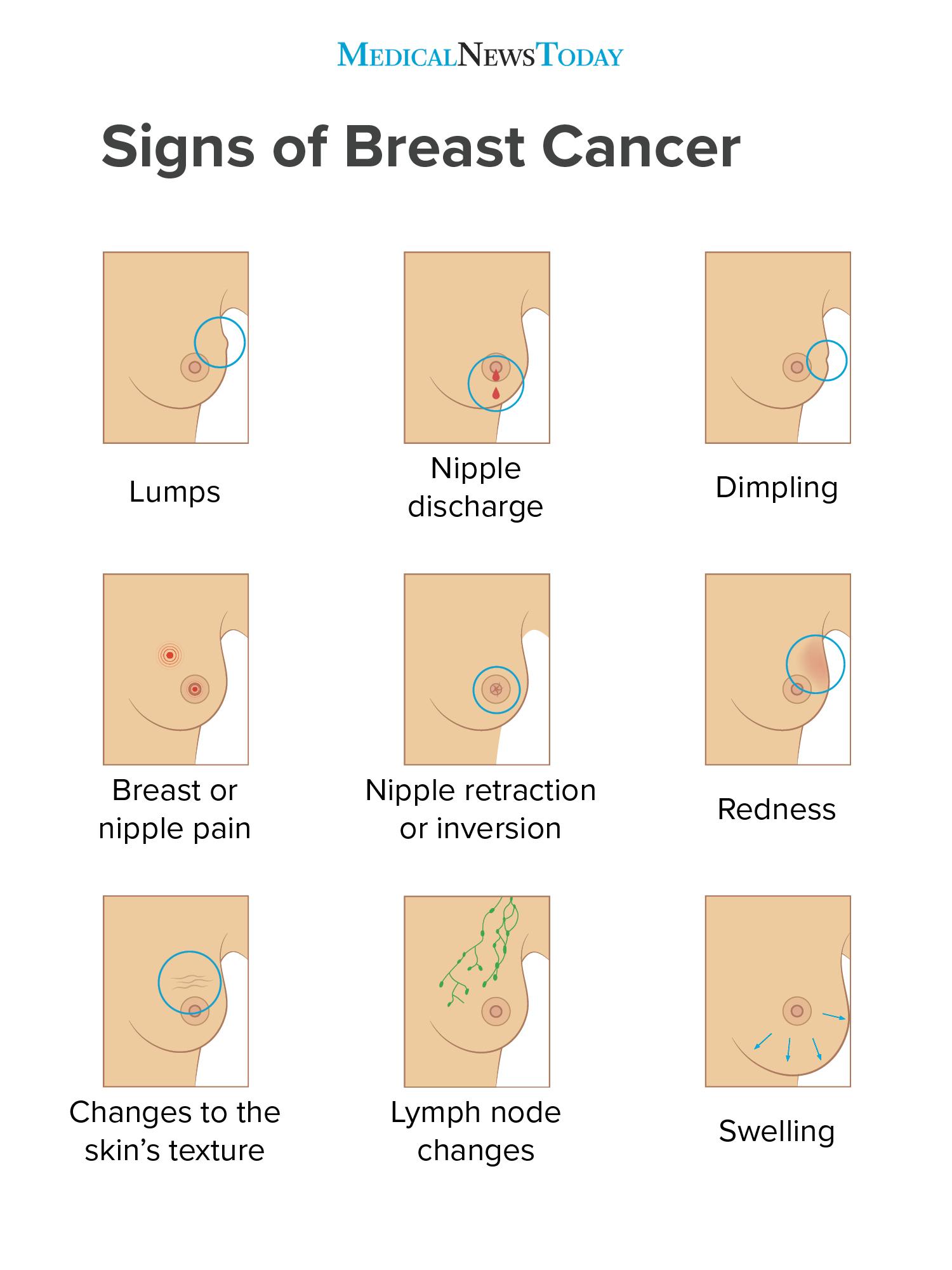 What Does Breast Cancer Lump Feel Like - CancerWalls