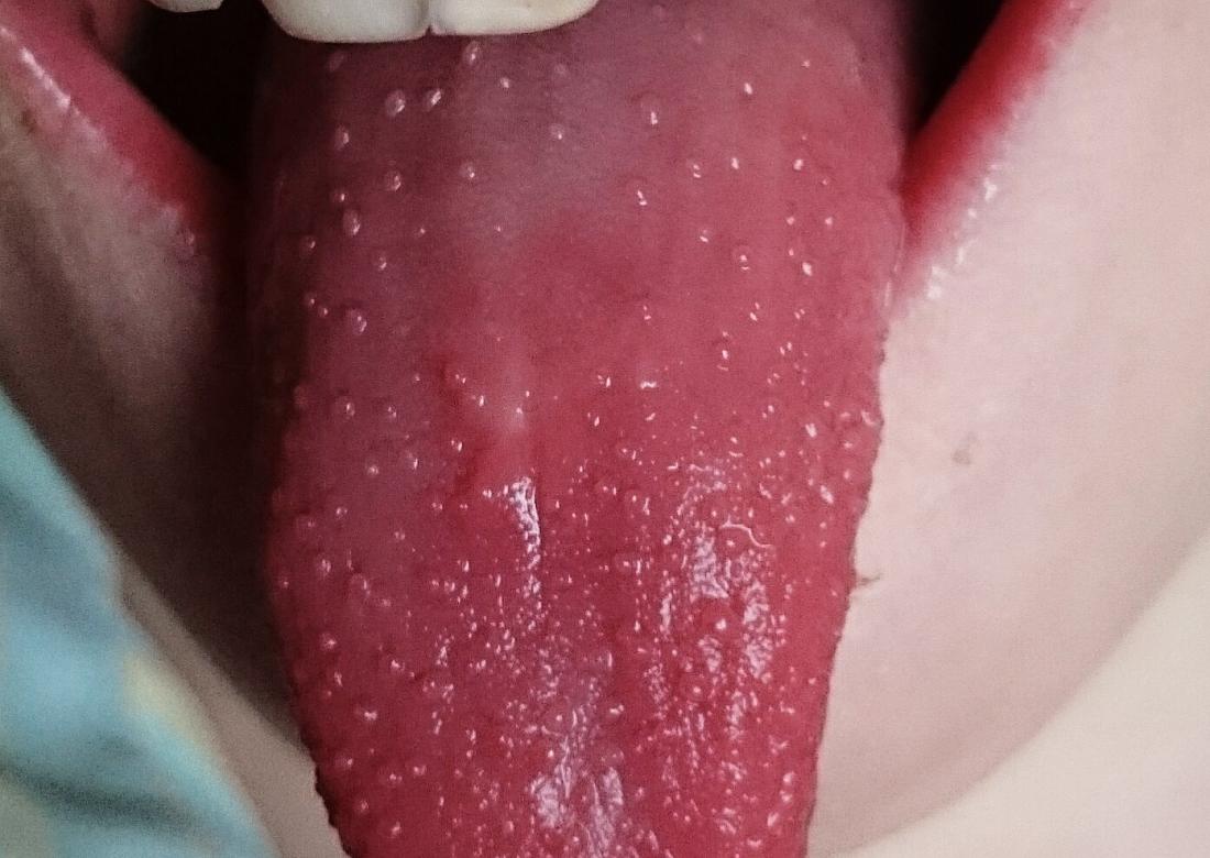 Spots On Tongue Causes And When To See A Doctor