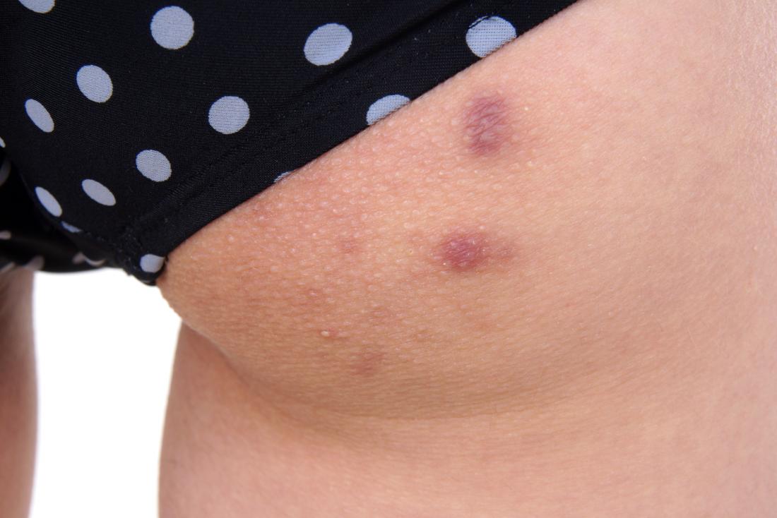 Why you get bum spots and how to get rid of them