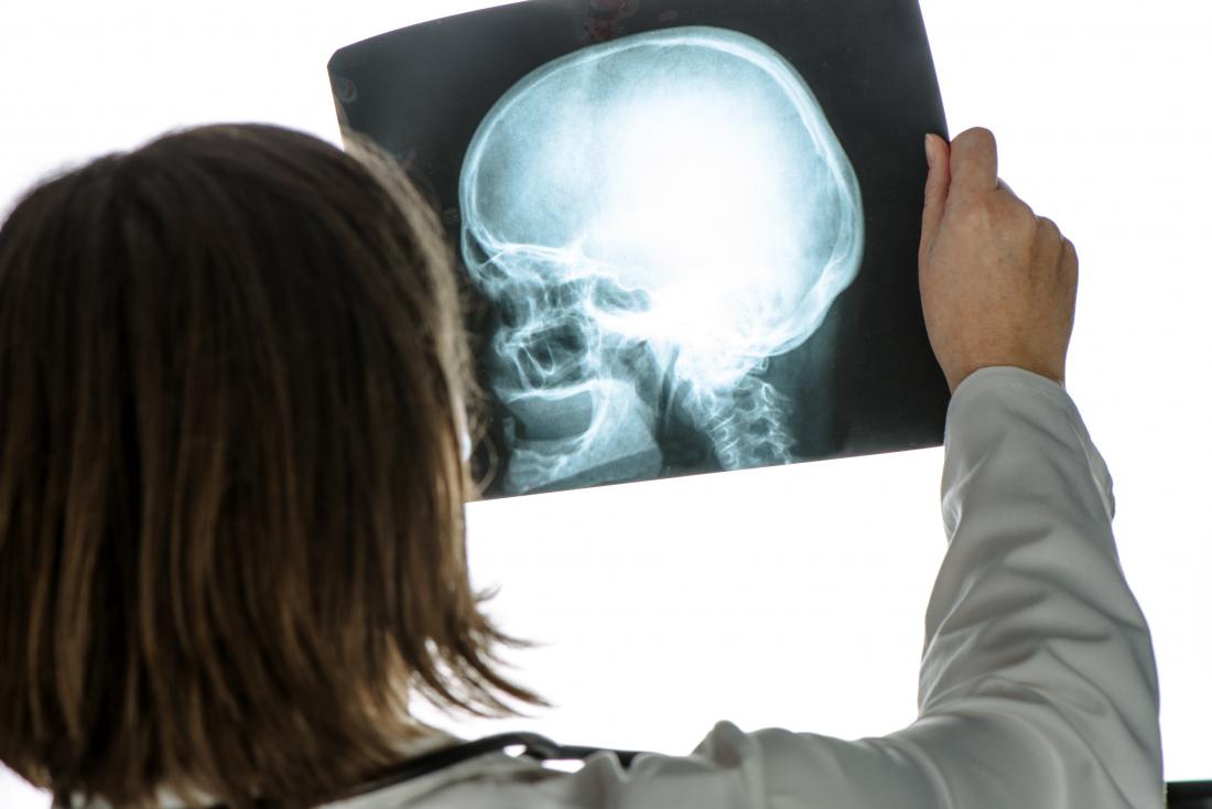 Skull Fracture: What It Is, Causes, Symptoms, Types & Treatments