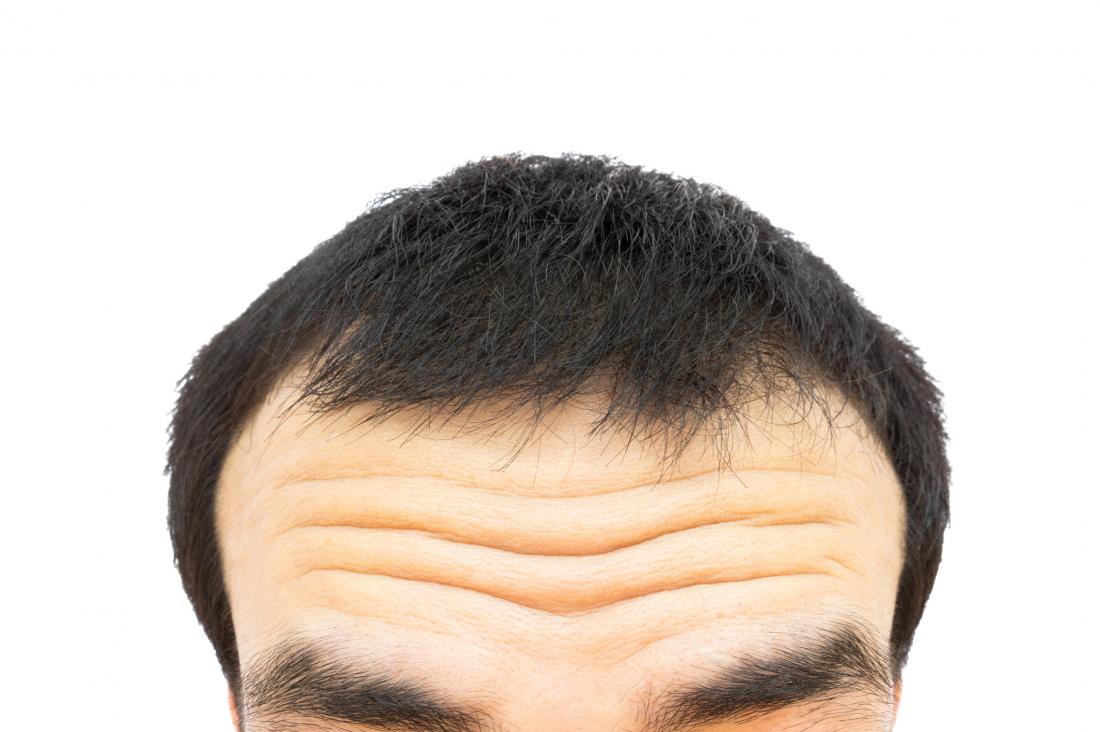 https://cdn-prod.medicalnewstoday.com/content/images/articles/322/322887/close-up-of-wrinkles-on-man-s-forehead.jpg
