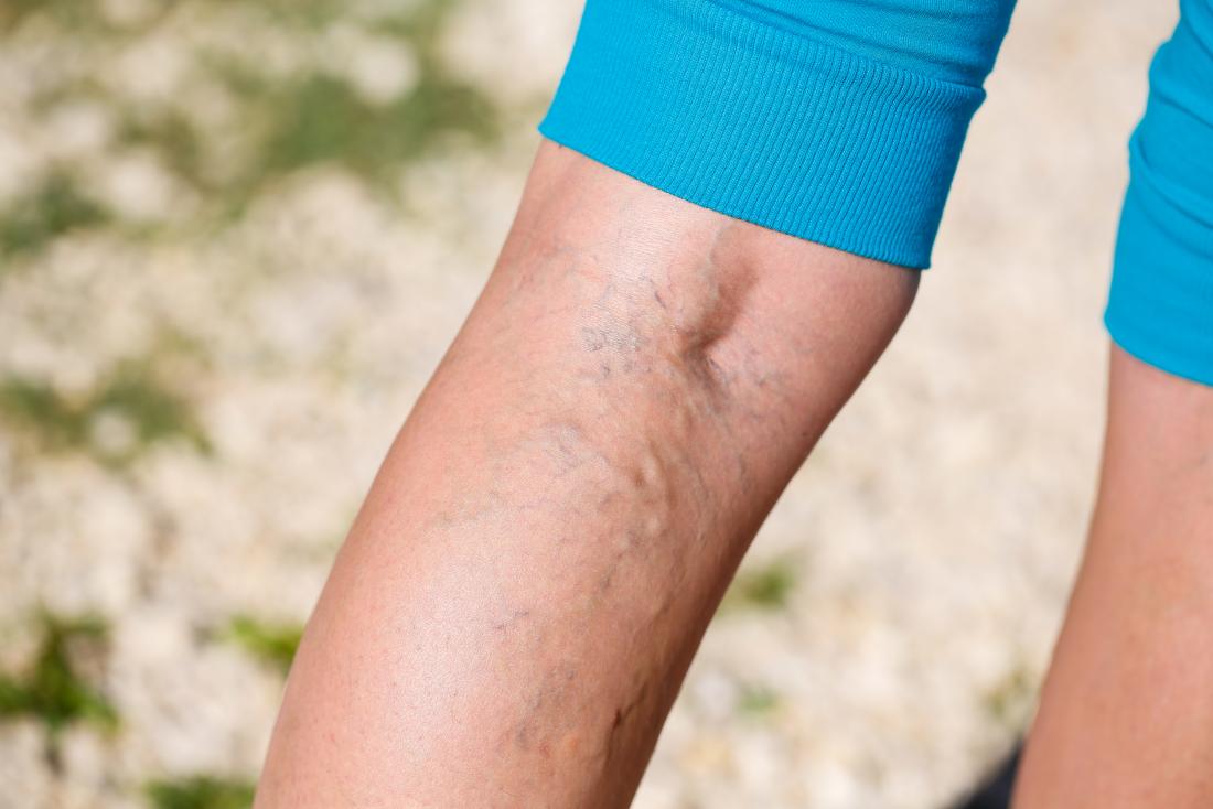 stasis dermatitis and ulcers varicose veins