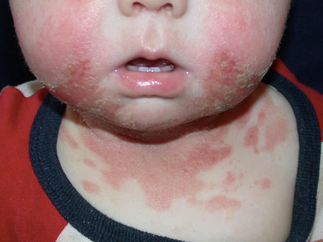 Baby weaning red rash around mouth