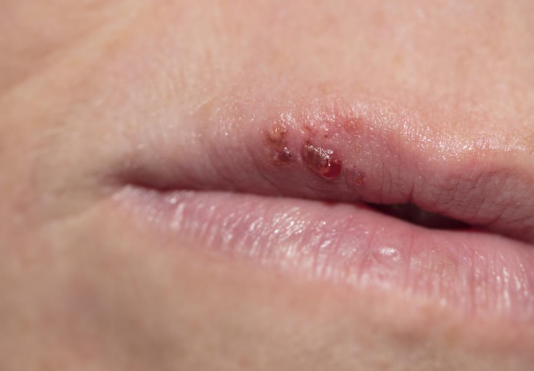 Red Bump On My Lip