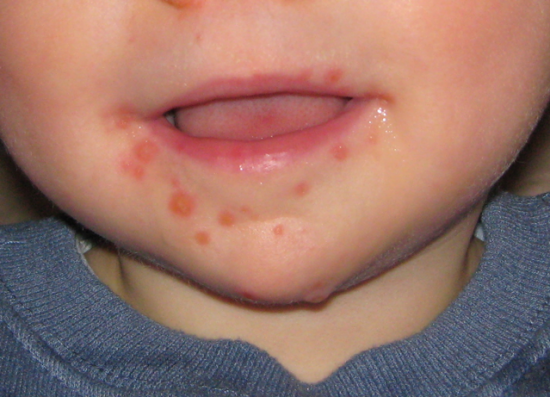 Toddler red spots around mouth after eating