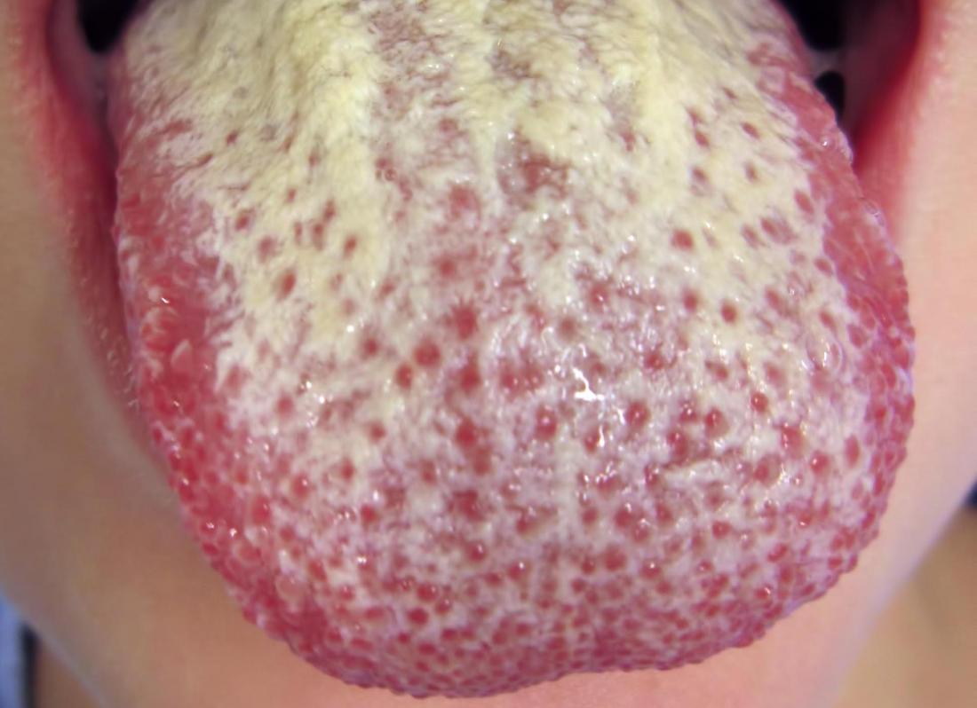 Oral thrush on tongue