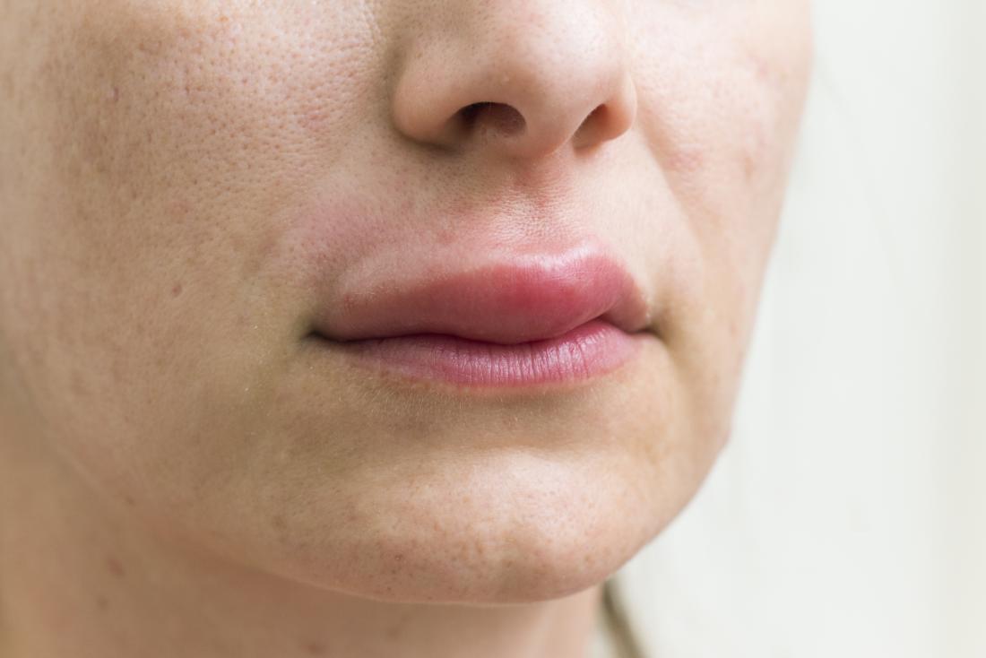 bump on upper lip