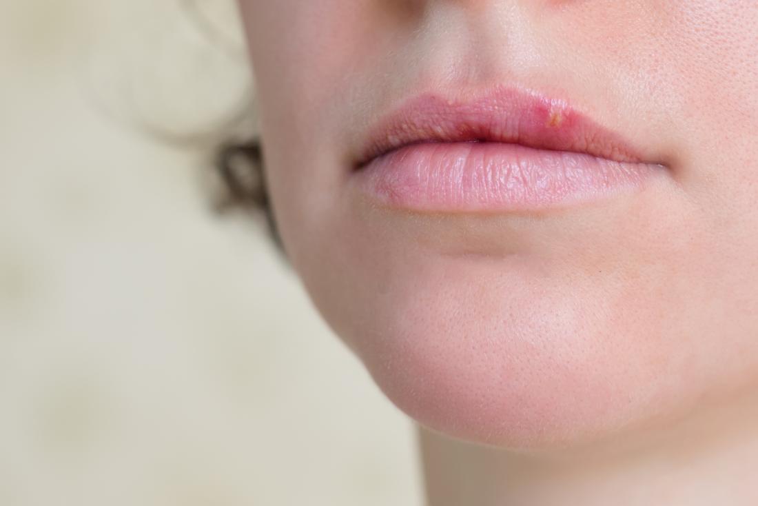 bump on upper lip