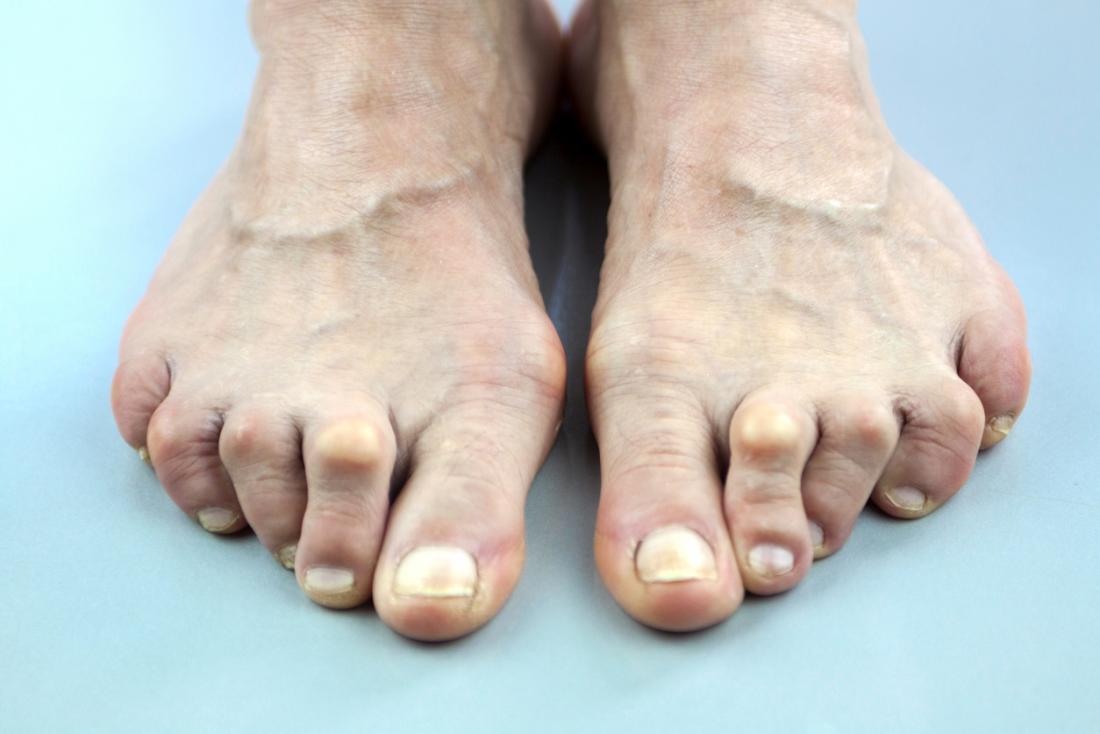 arthritis in feet and toes