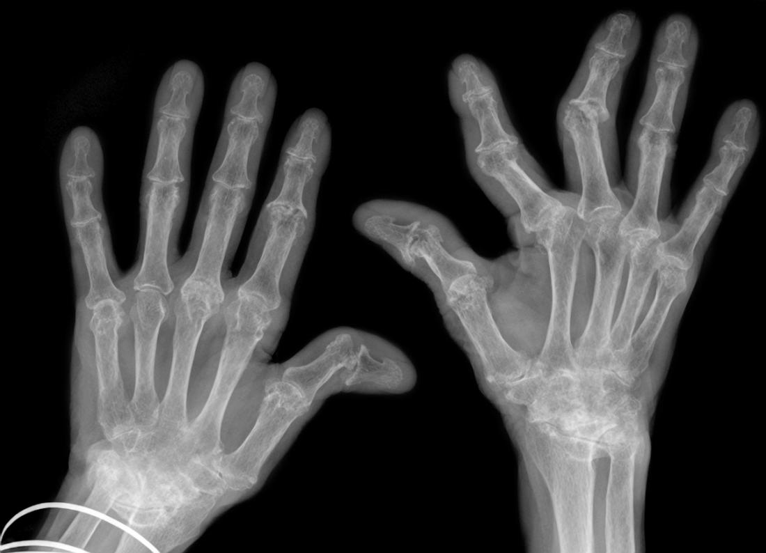 cracking arthritis