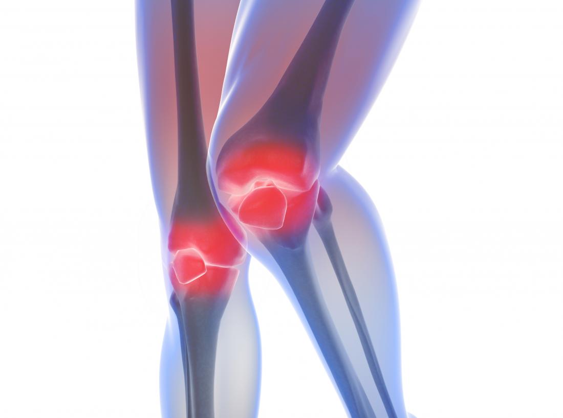 Rheumatoid Arthritis Pictures: Symptoms In The Joints