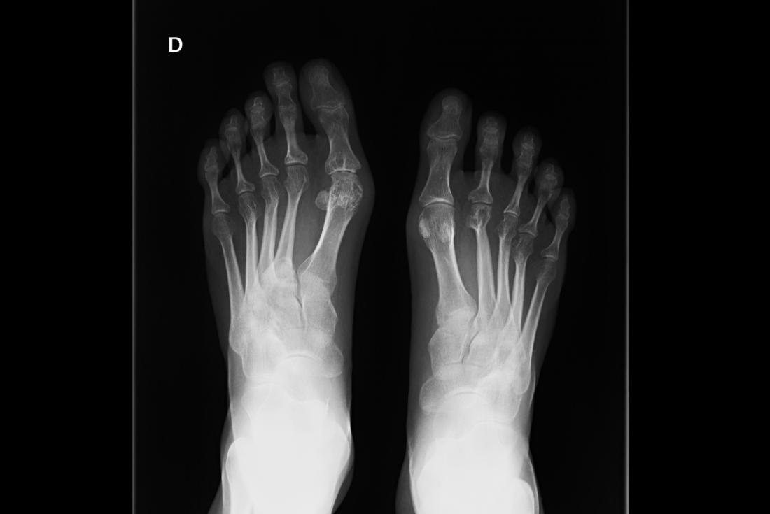 rheumatoid-arthritis-pictures-symptoms-in-the-joints