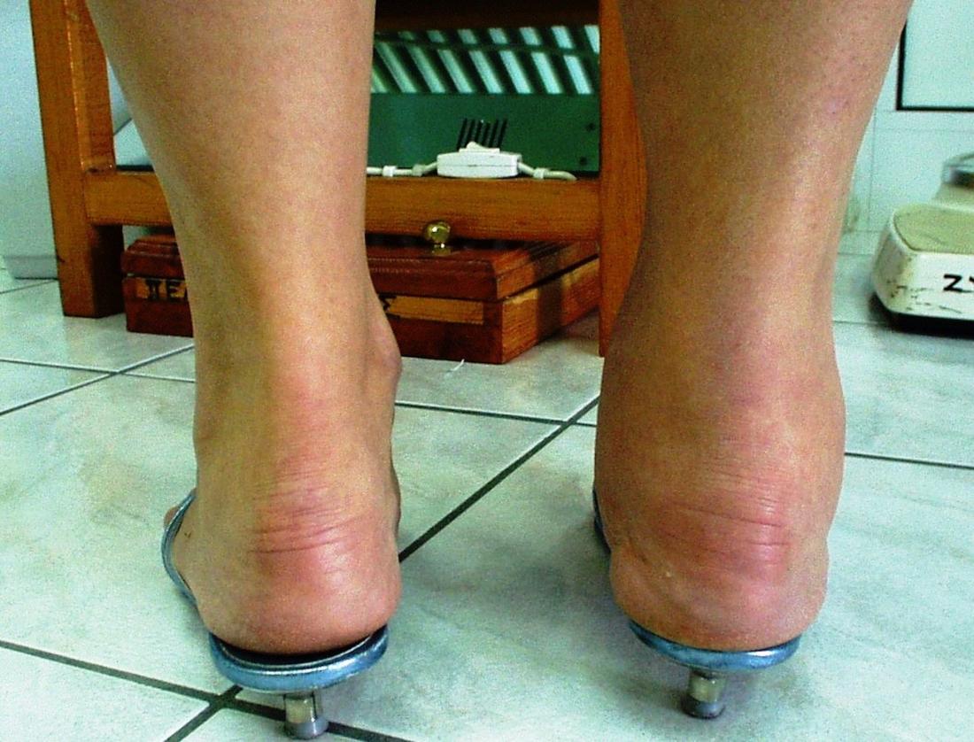 swollen ankles and heel pain