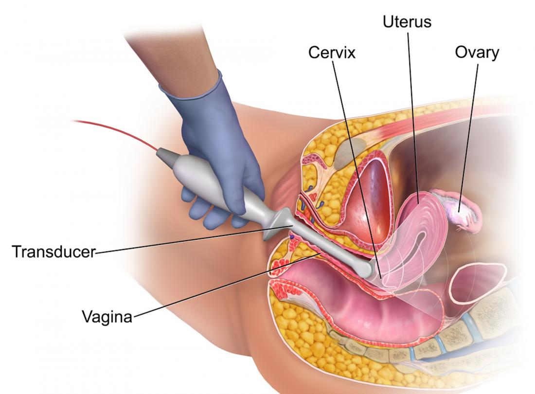 Transvaginal ultrasound: Uses and what to expect