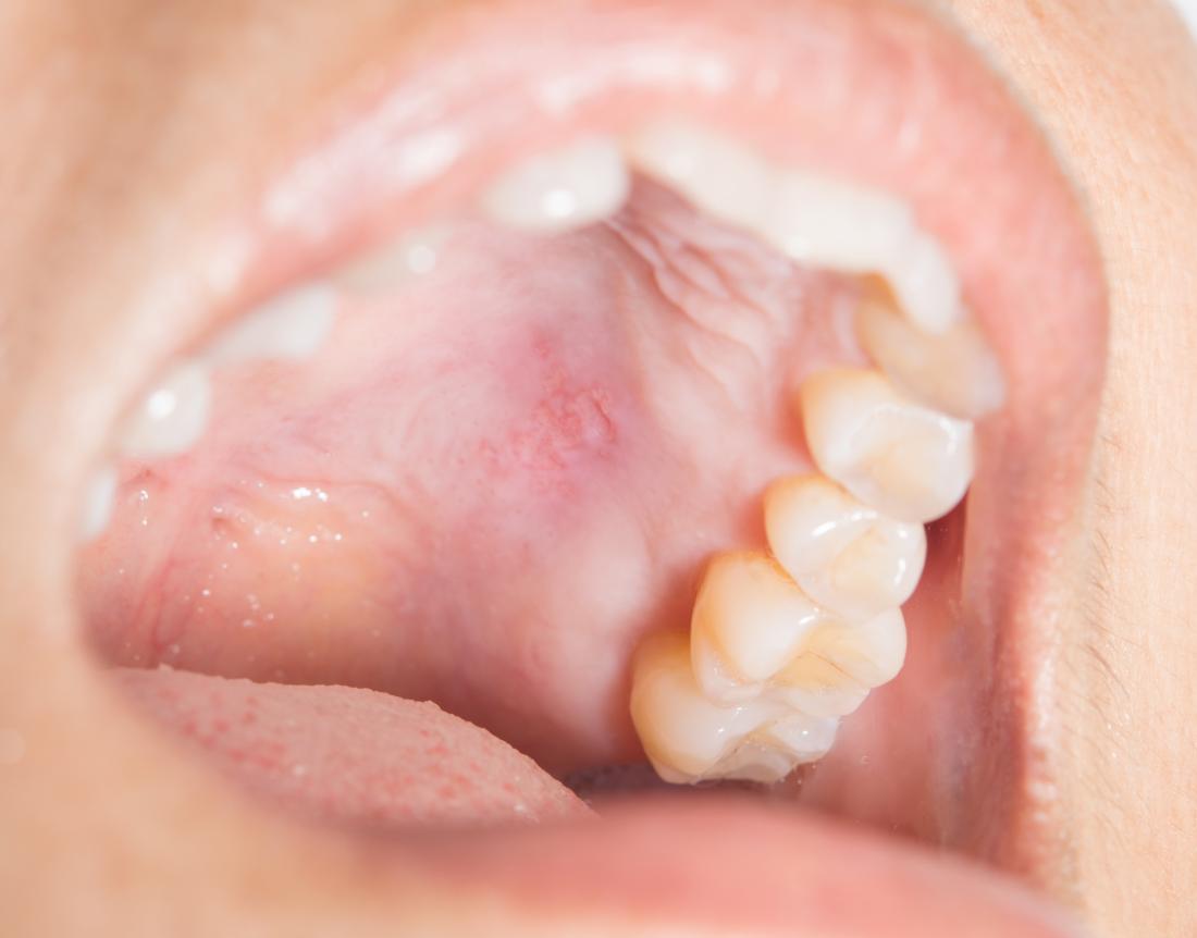 Bump On The Roof Of The Mouth 12 Causes   Canker Sore On The Roof Of The Mouth 