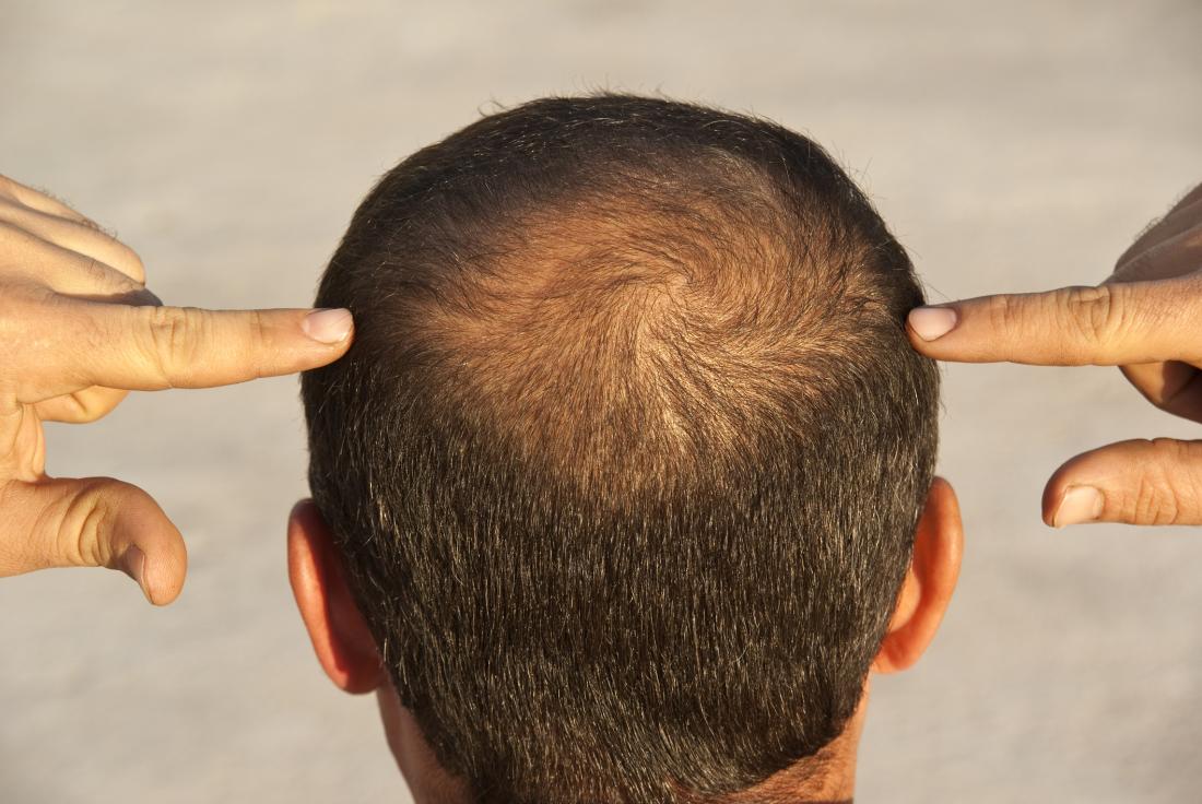 Hair regrowth in 2 patients with recalcitrant central centrifugal  cicatricial alopecia after use of topical metformin - JAAD Case Reports