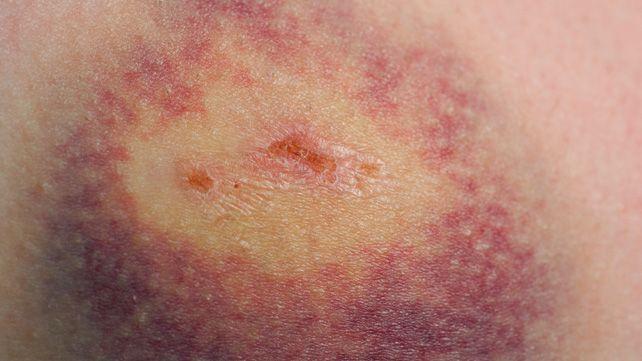 Leukemia rash: Pictures, symptoms, and when to see a doctor