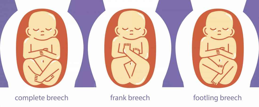 breech presentation in pregnancy means