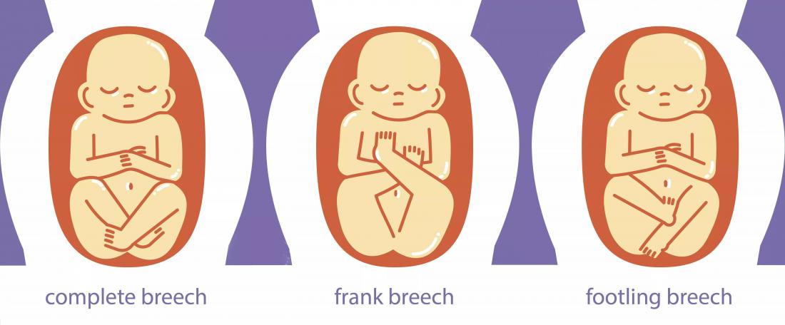 breech presentation at 12 weeks