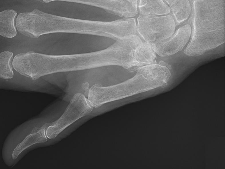 thumb arthritis)