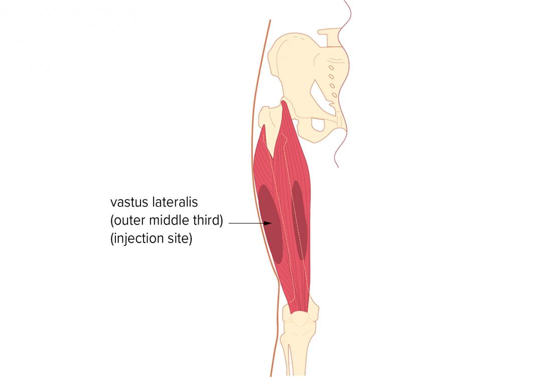 Intramuscular Injection Locations And Administration   Intramuscular Injection Vastus Lateralis Br Image Credit British Columbia Institute Of Technology Bcit 2017 Br 