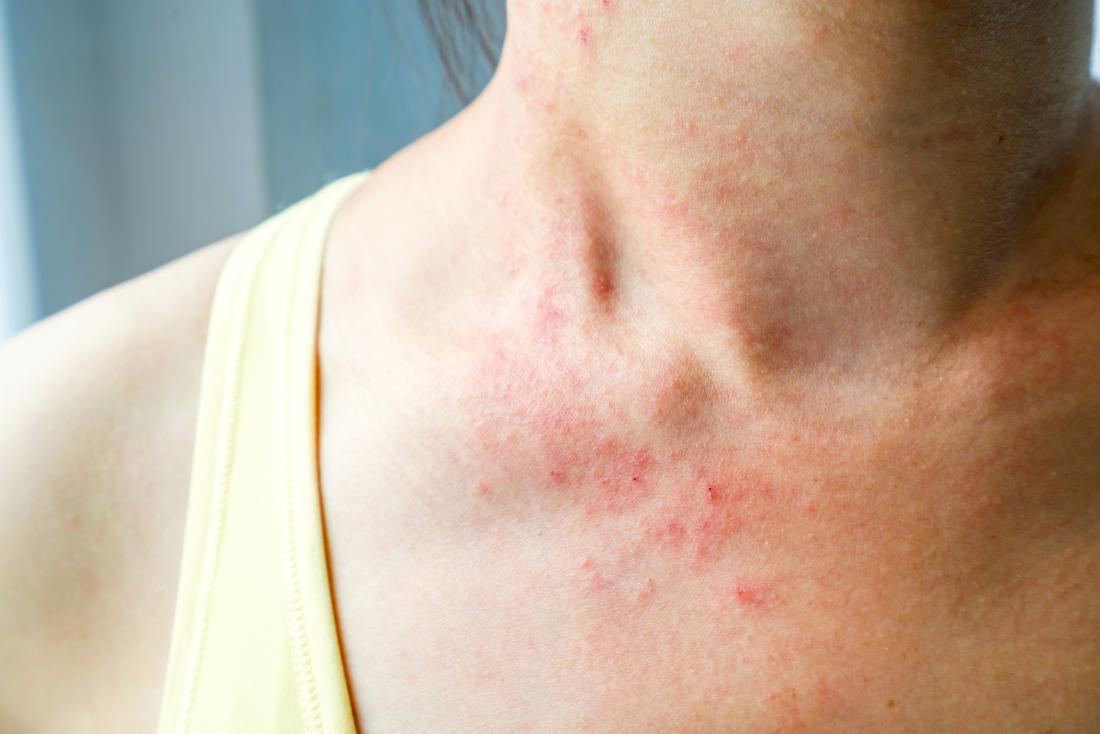 Chlorine rash: Symptoms, causes, and treatment