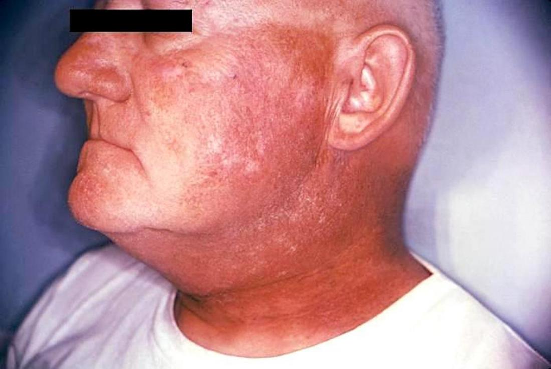Radiation dermatitis. Image credit: CDC/ Robert E. Sumpter, 1967