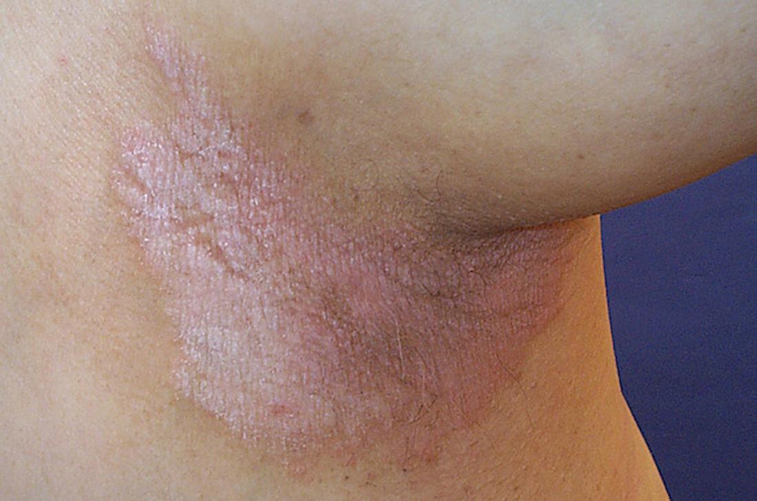 A Ripple Effect of Groin Skin Issues