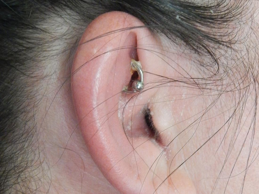 Infected Ear Piercing Symptoms Treatment And Prevention