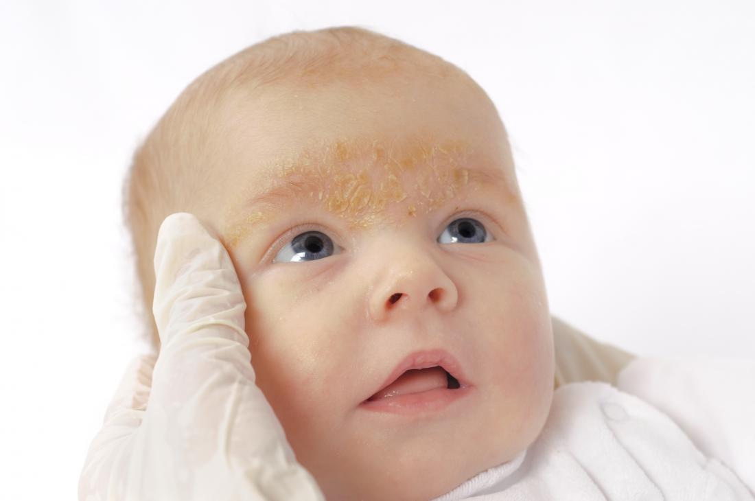 Baby rash on face neck and arms