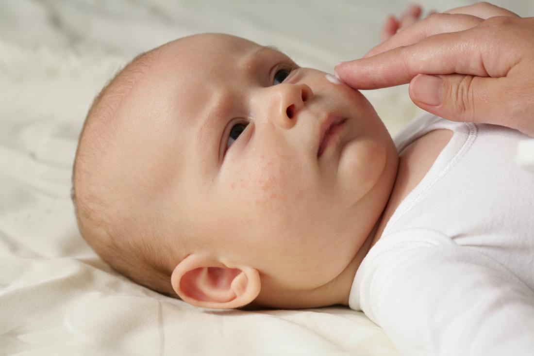 What causes a baby to have rash on face and body