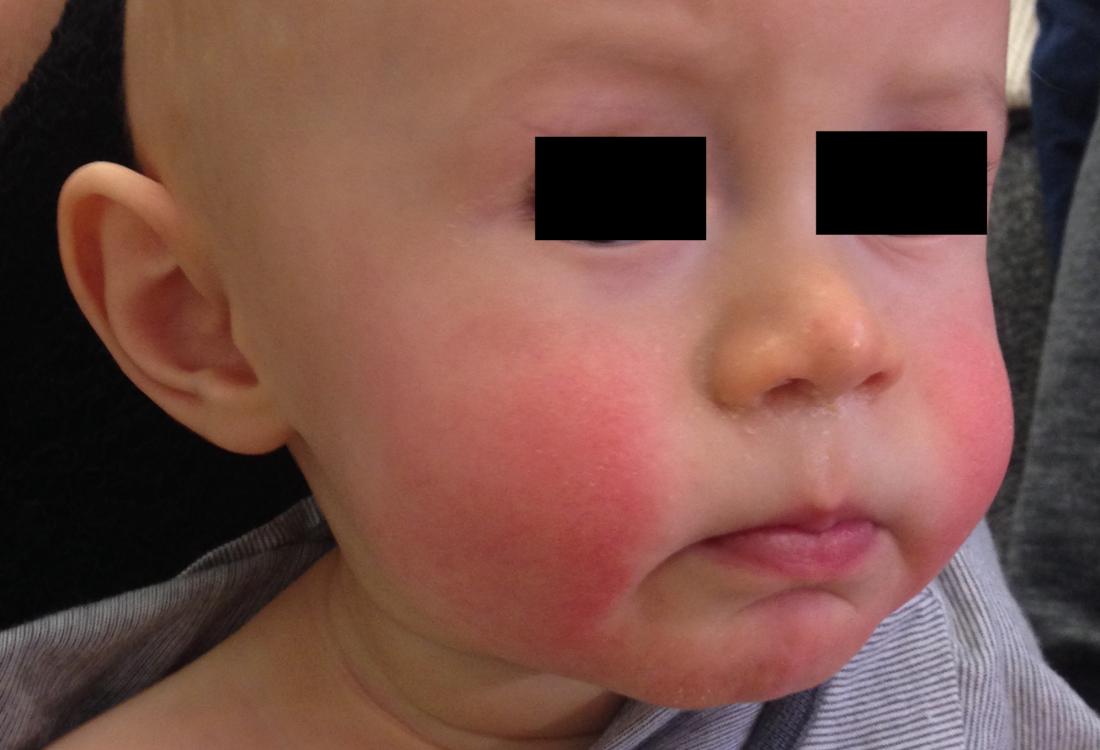 Sudden rash on baby face