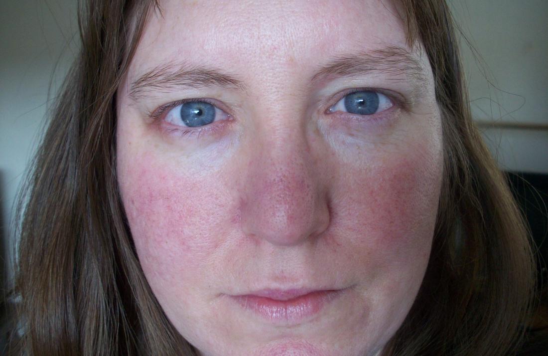 Flushed or red skin on womans face. Image credit: Alisha Vargas, 2010