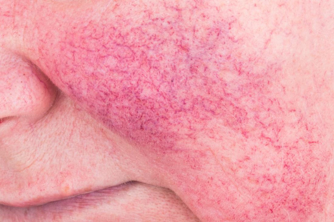 Rosacea on cheek