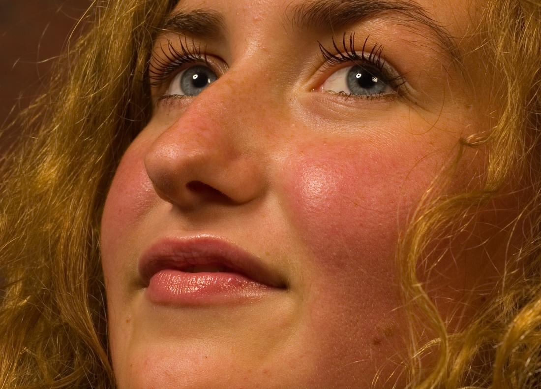 WOMAN WITH ROSY CHEEKS and flushed skin blushing