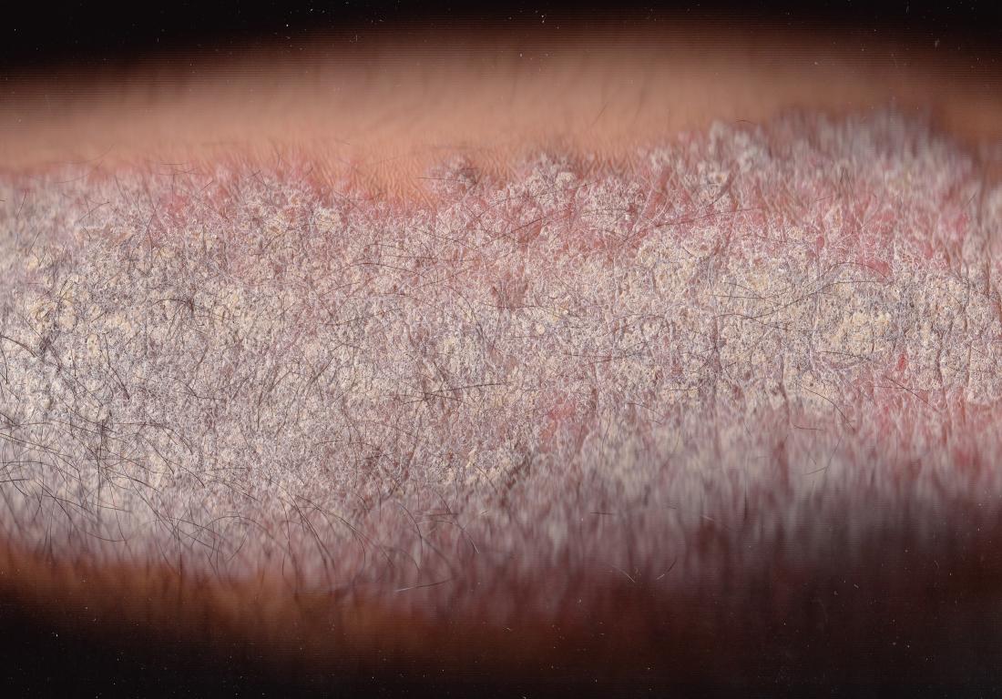 plaque-psoriasis-pictures-symptoms-and-severity