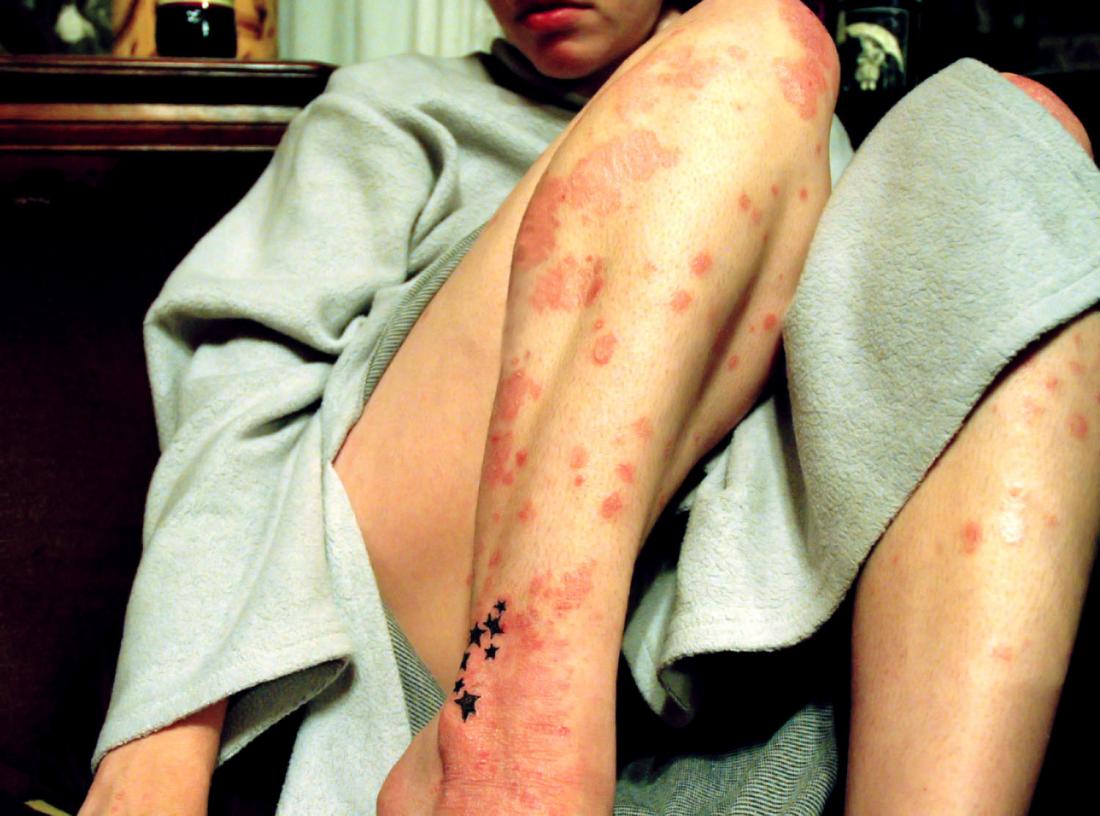 Plaque psoriasis on a womans leg <br>Image credit: Mysi Ann, 2007</br>