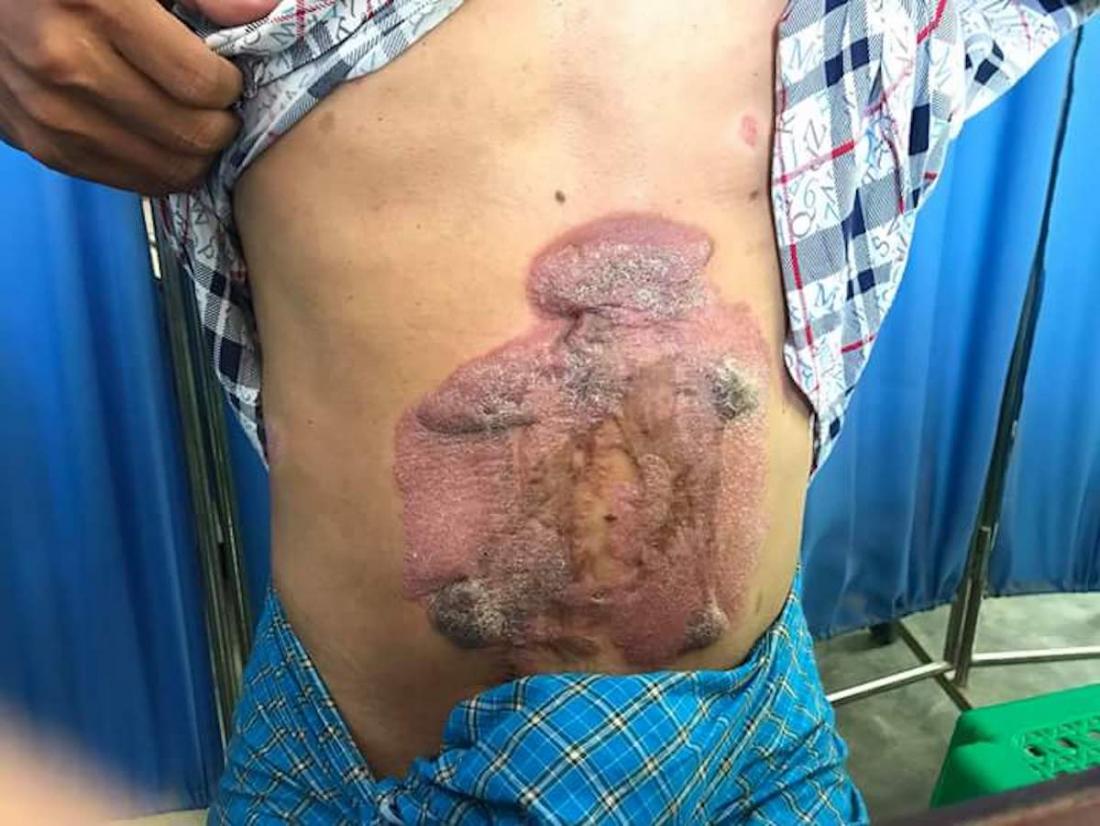 Psoriasis on the torso <br>Image credit: Mohammad2018, 2018</br>