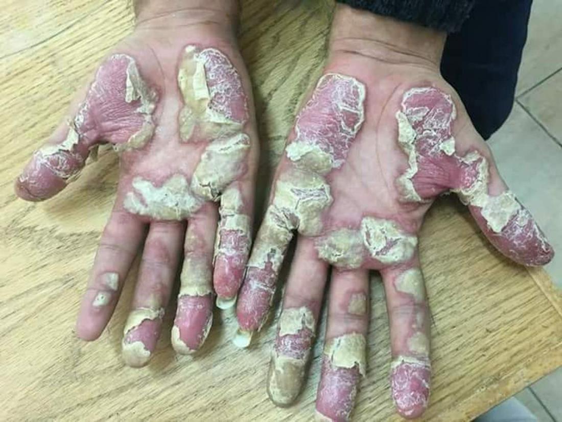 Psoriasis pustule <br>Image credit: Mohammad2018, 2018</br>