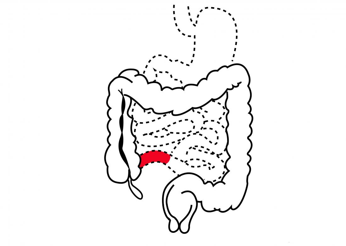 Crohn's disease surgery: Types, complications, and recovery