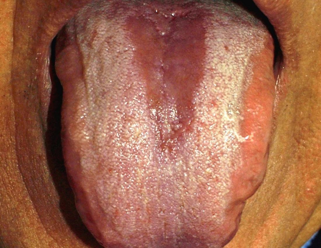 Crohn S Mouth Ulcers Symptoms Causes And Treatments