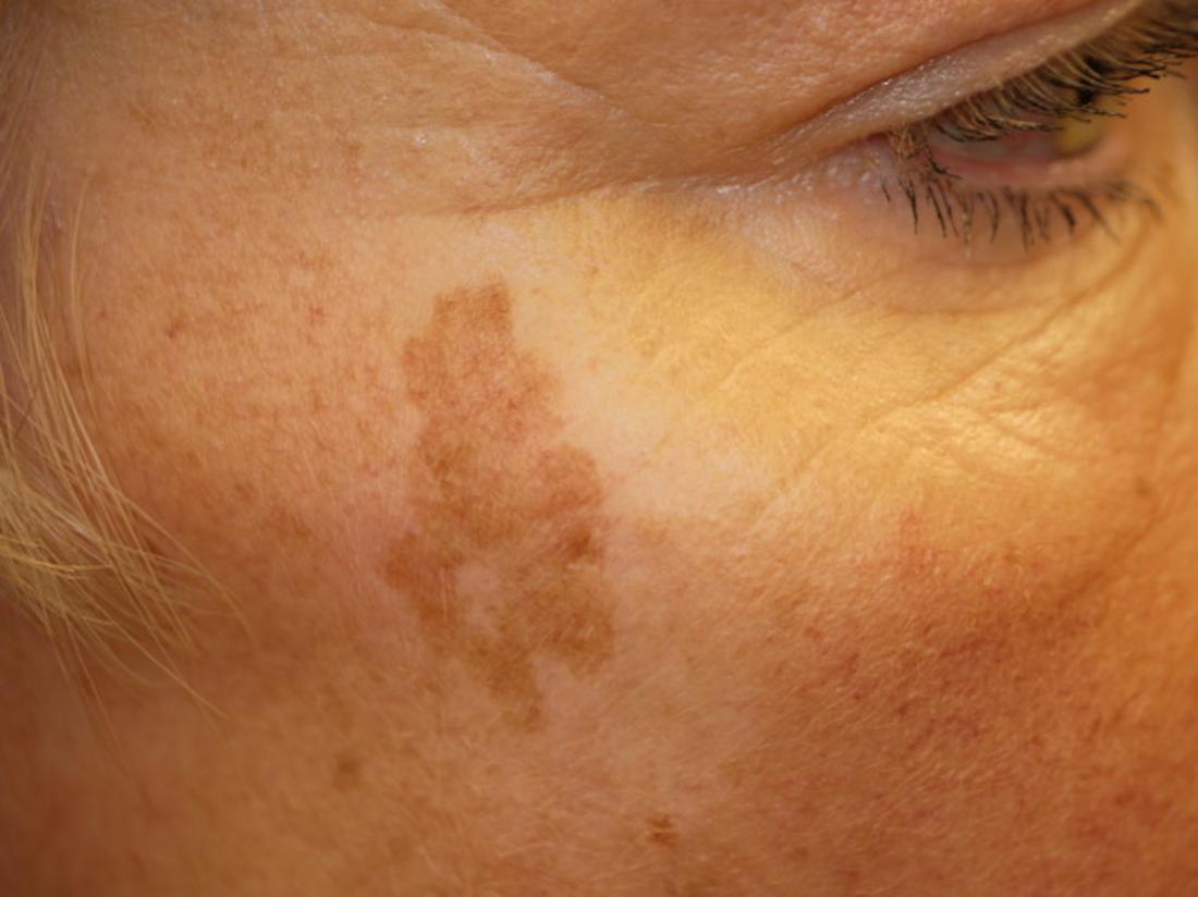 What's The Difference Between Freckles And Sun Spots?: Center Aesthetic &  Dermatology