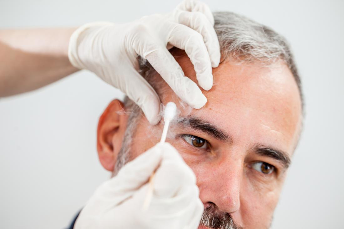 Cryotherapy being used on an age spot