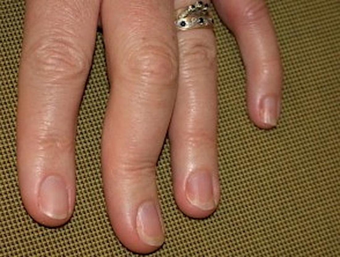 Psoriatic Arthritis In The Hands Symptoms Pictures And Treatment