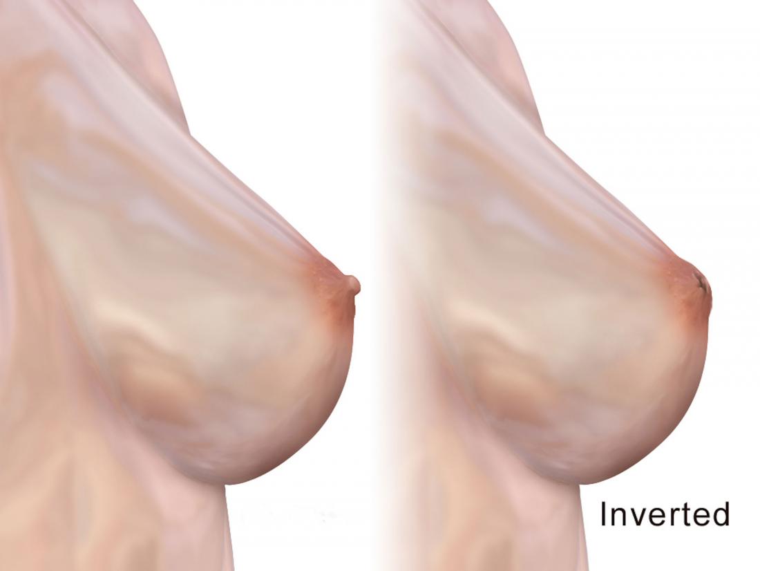 Flat or inverted nipple treatment