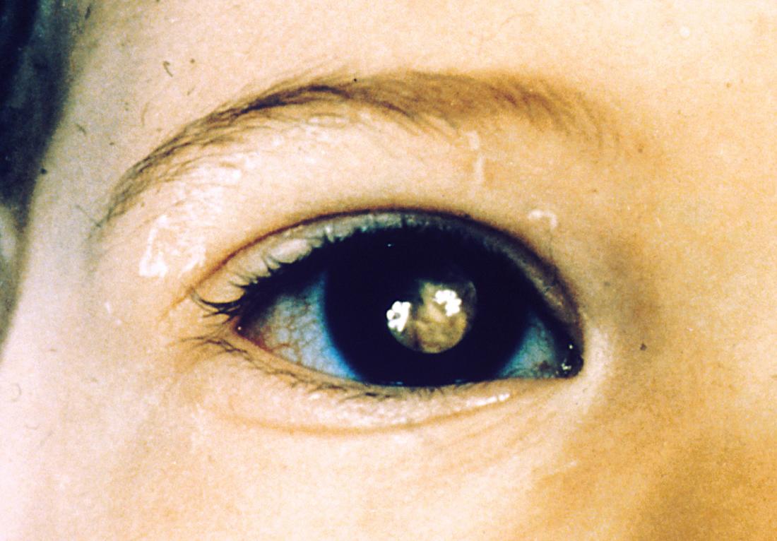 white-spot-on-eye-causes-symptoms-and-treatment